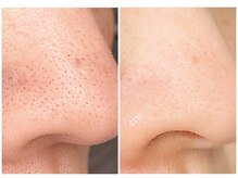 毛穴大掃除で即つるん♪毛穴ハイドロピーリング