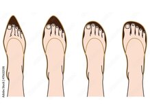 ネイルサロン チェリッシュ(Nailsalon Cherish)/巻き爪はお履き物の選定大事です