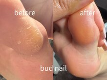 バドゥネイル(bud nail)