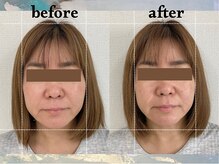 寝譜(nefu)/美容鍼BeforeAfter