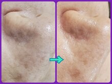 マニル アンド ネトラ(manil & netola)/ハイドロ＋ヒト幹細胞培養液導入