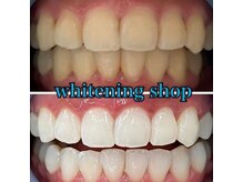 ホワイトニングショップ 長岡京店/ホワイトニングビフォーアフター