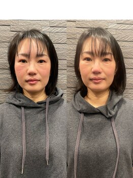 長寿鍼灸院 長寿整骨院/美容鍼50本の効果★小顔効果