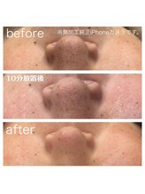 ラクシー 北千住(luxssy)/3D毛穴洗浄