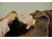 ビューティーパンク 黒田鍼治療院(Beauty Punc)/6.美容鍼なのに目の疲れに