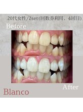 ブランコ 川口店(Blanco)/セルフホワイトニング　症例写真