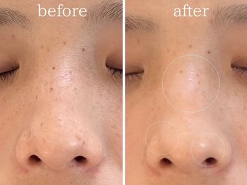 リッシュベル(RicheBelle..)/シミケア