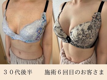 ラーナ(Lana)/バストアップ症例