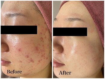 フルリールボーテ(Fleurir Beaut)/ニキビ毛穴