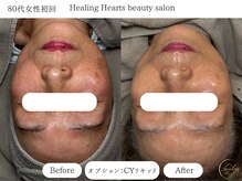 ヒーリングハーツ(Healing Hearts)/いつまでも美しさは探求するもの