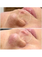 ナインオブカップス(9 of cups)/フェイシャルWax/艶肌Wax/顔脱毛