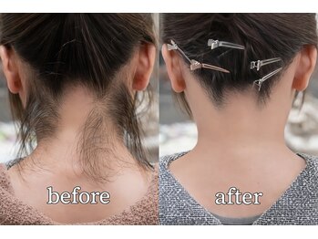 タイズ ヘアーリムーバルアンドアイラッシュ(ties)/ピンポイントで部分施術もOK★