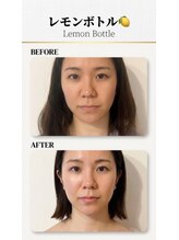 ブリリアントスマイル/お顔がほっそりしたい方へ