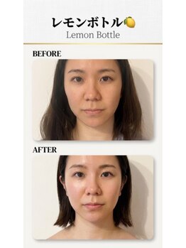 ブリリアントスマイル/お顔がほっそりしたい方へ