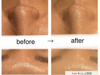 リュクスアンドコー 上田店(Luxe&co.)の写真/【毛穴ケア×顔脱毛】毛穴レス/広がり毛穴/角質ケア/テカリと顔脱毛が同時に叶う♪初回20％オフ

