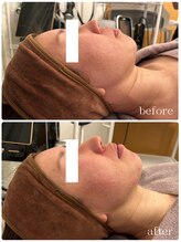 メゾンリュバン 梅田店(Maison Ruban)/エステ版オンダリフトプロ