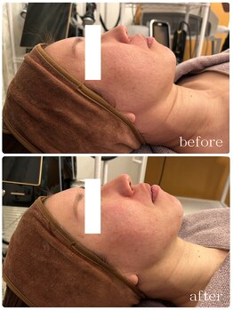 メゾンリュバン 梅田店(Maison Ruban)/エステ版オンダリフトプロ