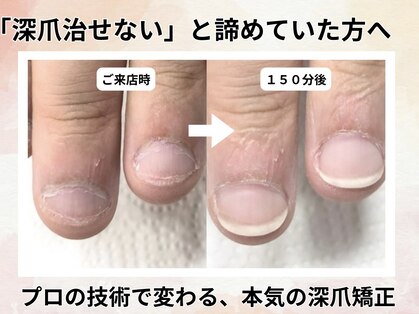 深爪矯正専門ネイルサロン アニューの写真