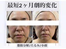 サロンドボーテ ベル(SALONDEBEAUTE BELLE)の雰囲気（脂肪をコントロールするだけで見た目は変えられる。小顔／たるみ）