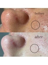 シャルム ド ケー(charme de k)/最強毛穴洗浄