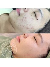 ハス(hasu.)/リベルハーブピーリング 