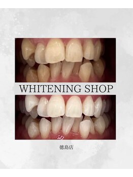 ホワイトニングショップ 徳島店/Before&After美白ホワイトニング