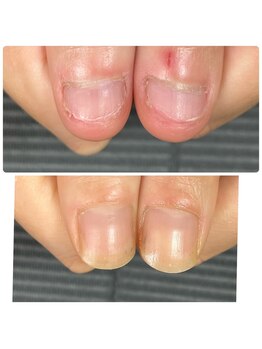 ウェルズユキ(well's yuki)/自爪を縦長にしたい!