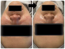 エフェクト 塚口店(effect)/Before &nbsp;&nbsp;after 30代/1回目