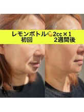 ララチッタ(L'la citta)/レモンボトル2cc