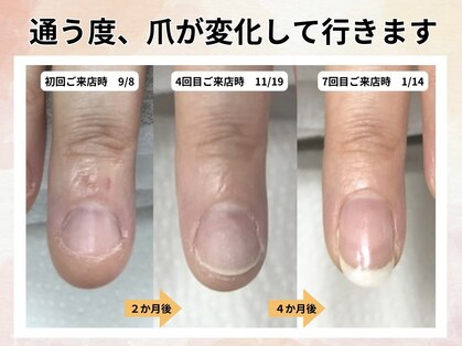 深爪矯正専門ネイルサロン アニューの写真