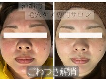 フワリの雰囲気（肌質改善ピーリング11800円ニキビケア/シミケア/しわケア/美白）