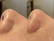 ルゥルゥ シュガーリング(Luu Luu sugaring)/毛穴エクストラクション