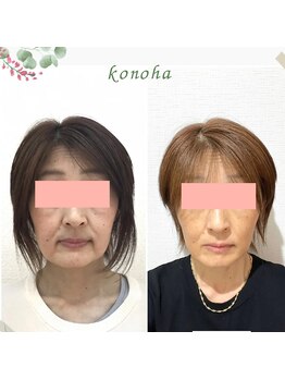 木の葉/50代/輪郭,ハリツヤ・たるみ改善