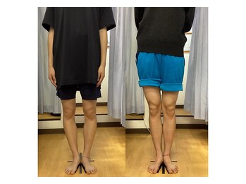 キュア整骨院(CURE整骨院)/Ｏ脚矯正コース実績４