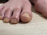 【フット】巻き爪でお悩みの方！巻き爪補正ケアコース /￥11000→¥10000