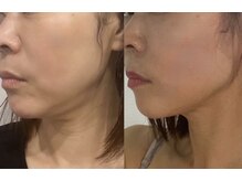 ミルジュ(MiLuJu)/美容溶解エンマ