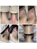 【女性】『うなじWAX+うなじ光』＝W脱毛