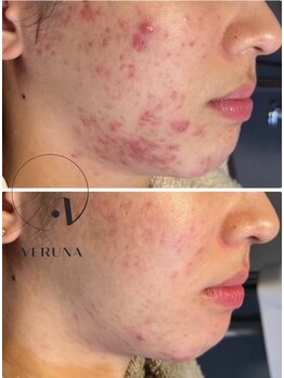 ココ 2号店(CoCo)/ニキビケア