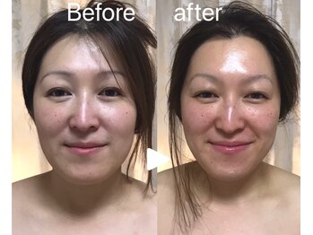 ルチア(LUCIA)/ブライダルエステ6回コース