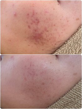 アネモネ(ANEMONE)/韓国式ハーブピーリング