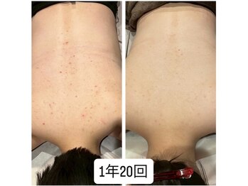 ビアラ(美ala)/背中ニキビケア/1年20回