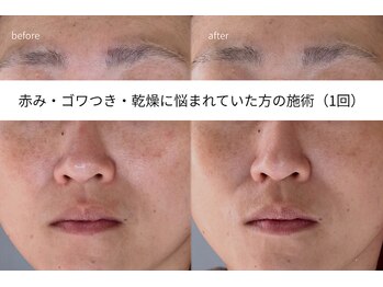 アイリス(iris)/ニョキっと角栓ケアで潤い素肌