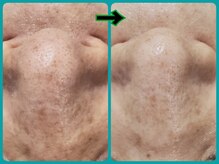 マニル アンド ネトラ(manil & netola)/ハイドロ＋ヒト幹細胞培養液導入