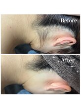 ファム(fam.)/イベント前、撮影前の脱毛に