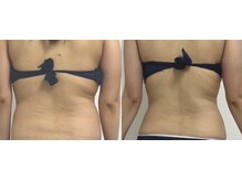 プリマルーチェ/プレミアム背中プログラム