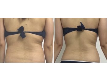 プリマルーチェ/プレミアム背中プログラム