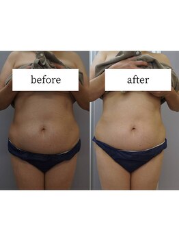 アップルミント/＜痩身＞before・after