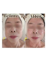 セッテベレッザ(Sette Bellezza)/ハーブピーリング・２Bバイオ