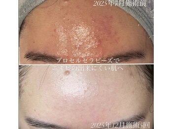 テテメルティ(te-te melty)/プロセルセラピーズ