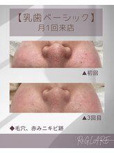 リグレア 浦安(Re.GLARE)/毛穴